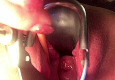 Cervix Stretched and Sounded—How Deep Can It Go?